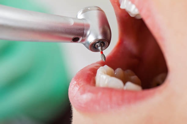 Best Dental Abscess Treatment in Dunlap, IN